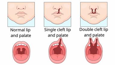 A normal lip and palate compared to two cleft lips and palates, showing a cleft on one side and on both sides of the face.