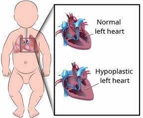 A child's body, with two images of the heart. One heart is normal. The other shows hypoplastic left heart syndrome.
