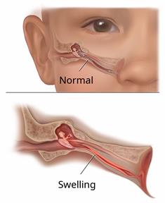 Part of a child's face, showing a normal middle ear and a close-up of a middle ear that has swelling.