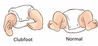 Comparison of babies' feet: one baby has club feet and the other has normal feet.