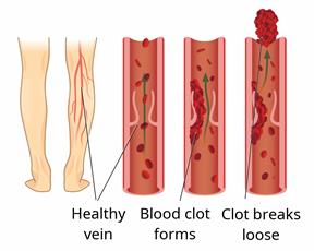 A person's legs with close-ups showing a normal vein, a vein with a blood clot, and a blood clot that breaks loose.