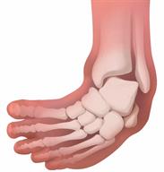 Outline of a baby's foot showing the position of the bones if the baby has club foot.