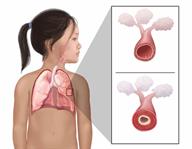 A child's upper body, showing the lungs, with close-ups of two airways, one normal and one narrow.