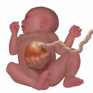 A baby who has a sac of organs outside their abdomen. The sac is connected to the umbilical cord.
