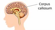 Side of a child's head showing the corpus callosum.
