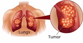 A torso showing the lungs, highlighting a cancerous tumor.