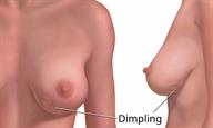 Front and side view of a breast showing dimpling.