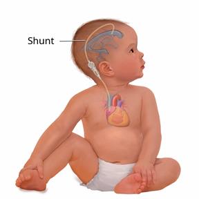 A baby with a shunt placed to drain fluid from the brain to another part of the body.