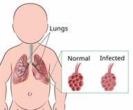 An outline of a baby with a view of the lungs and a close-up of part of a lung that is normal, and the same part infected.