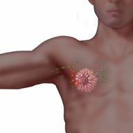 Male breast cancer, showing the lymph nodes.