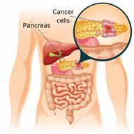 A body outline showing some digestive organs with a close-up of cancerous cells in the pancreas.
