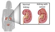 The urinary tract with a close up of a normal kidney and a kidney with cancer.