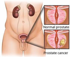 The male reproductive system, with a close-up of a normal prostate and a prostate with cancer.