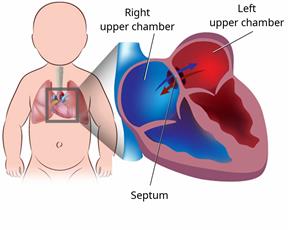 An infant's body, showing the heart inside the chest, with a close-up view of an atrial septal defect.