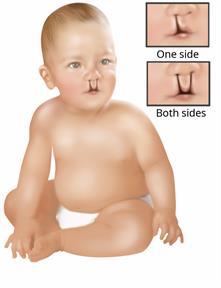 A baby with a cleft lip with close-ups showing a split on one side and on both sides of the top lip. 