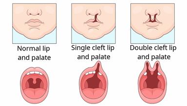 A normal lip and palate compared to two cleft lips and palates, showing a cleft on one side and on both sides of the face.