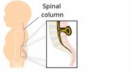 Side view of a baby's spine with a close-up of a small pouch containing the spinal cord, fluid, and nerves.
