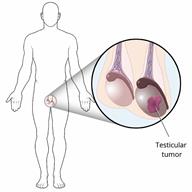 Outline of the male body, with a close-up of the testicles. One testicle has a tumor on it. 