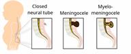 Side view of a baby's spine with close-ups showing a closed neural tube, a meningocele, and a myelomeningocele.