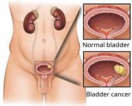 The front view of the lower body, showing the urinary system, with a close-up of a normal bladder and a bladder with cancer.