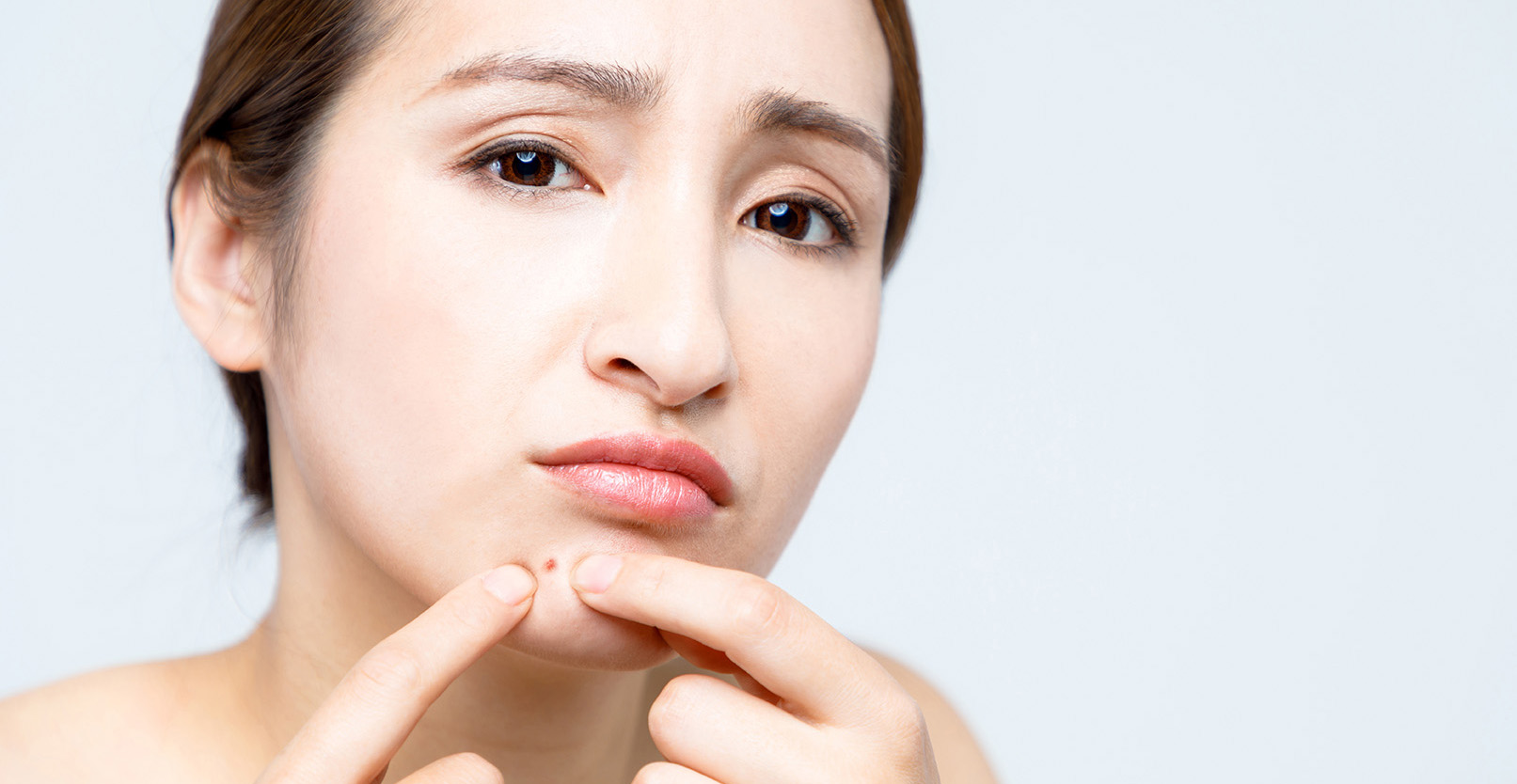 Treat Acne Without Breaking the Bank
