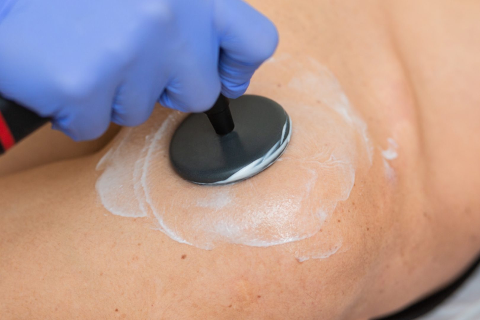 Terapia de Diatermia en Pilar Huertas Fisioterapia y Osteopatía