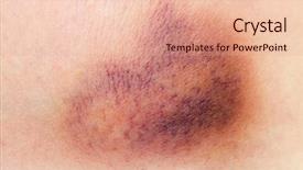  Presentation with wound - Presentation consisting of a bruise on wound background and a lemonade colored foreground