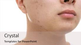  Presentation with acne - Presentation theme consisting of acne - young asian man with problem background and a mint green colored foreground