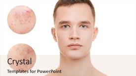  Presentation with skin infection - Colorful PPT theme enhanced with acne and skin care concept backdrop and a lemonade colored foreground