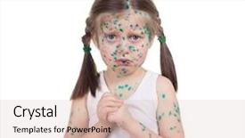  Presentation with acne - Amazing PPT theme having acne on child chickenpox backdrop and a  colored foreground