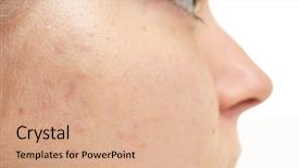  Presentation with indian woman bridal face - Slides consisting of acne vulgaris - face of beautiful young woman background and a coral colored foreground