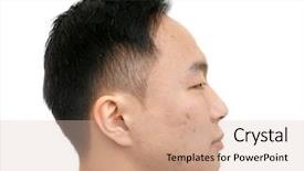  Presentation with asian nurse helps a man - Presentation enhanced with acne vulgaris - young asian man with problem background and a  colored foreground