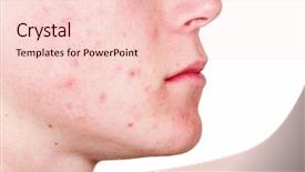  Presentation with acne - Audience pleasing slides consisting of acne backdrop and a lemonade colored foreground