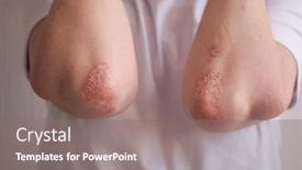  Presentation with arthritis - Amazing slides having acute-psoriasis-on-the-elbows backdrop and a gray colored foreground