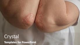  Presentation with arthritis - Theme having acute-psoriasis-on-the-elbows background and a gray colored foreground