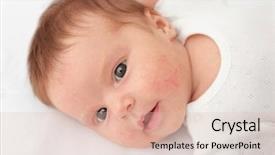  Presentation with allergy - Audience pleasing slides consisting of adorable baby with skin allergy backdrop and a lemonade colored foreground