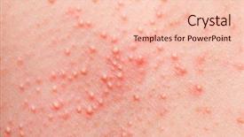  Presentation with body - Audience pleasing PPT theme consisting of allergic rash on the body backdrop and a lemonade colored foreground