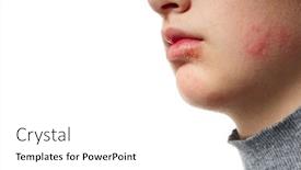  Presentation with skin disease - PPT layouts having allergic-reaction-skin-rash-close background and a white colored foreground
