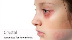  Presentation with skin disease - PPT theme with allergic-reaction-skin-rash-close background and a sky blue colored foreground