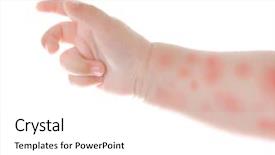  Presentation with babies - PPT theme with allergy - hand of little child background and a white colored foreground