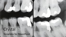  Presentation with periodontal - Cool new PPT layouts with alveolar bone - right periodontal x-rays backdrop and a light gray colored foreground