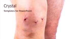  Presentation with knee - PPT theme consisting of anatomy - man knee after arthroscopic surgery background and a lemonade colored foreground