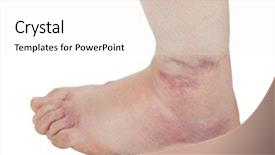  Presentation with ankle - Beautiful PPT layouts featuring ankle sprain backdrop and a white colored foreground