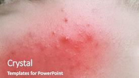  Presentation with anti virus - Colorful slide deck enhanced with anti virus - acne treatment concept skin irritation backdrop and a coral colored foreground