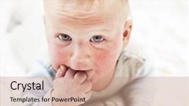  Presentation with dermatitis - Cool new presentation design with atop - little baby with dermatitis backdrop and a coral colored foreground