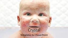  Presentation with dermatitis - Amazing PPT theme having atop - little baby with dermatitis backdrop and a coral colored foreground