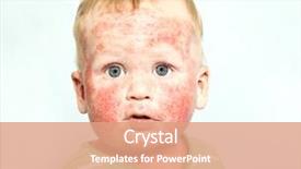  Presentation with dermatitis - Amazing PPT theme having atop - little baby with dermatitis backdrop and a coral colored foreground