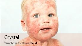  Presentation with dermatitis - Theme enhanced with atop - little baby with dermatitis background and a coral colored foreground