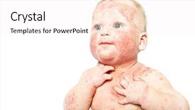  Presentation with dermatitis - Colorful slide deck enhanced with atop - little baby with dermatitis backdrop and a sky blue colored foreground