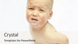  Presentation with dermatitis - Audience pleasing slides consisting of atop - little baby with dermatitis backdrop and a lemonade colored foreground